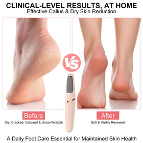 Innoflyx coarse-head callus remover for fast rough skin reduction