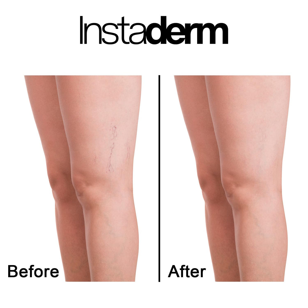 Sleek Instaderm bottle and packaging showing premium design.