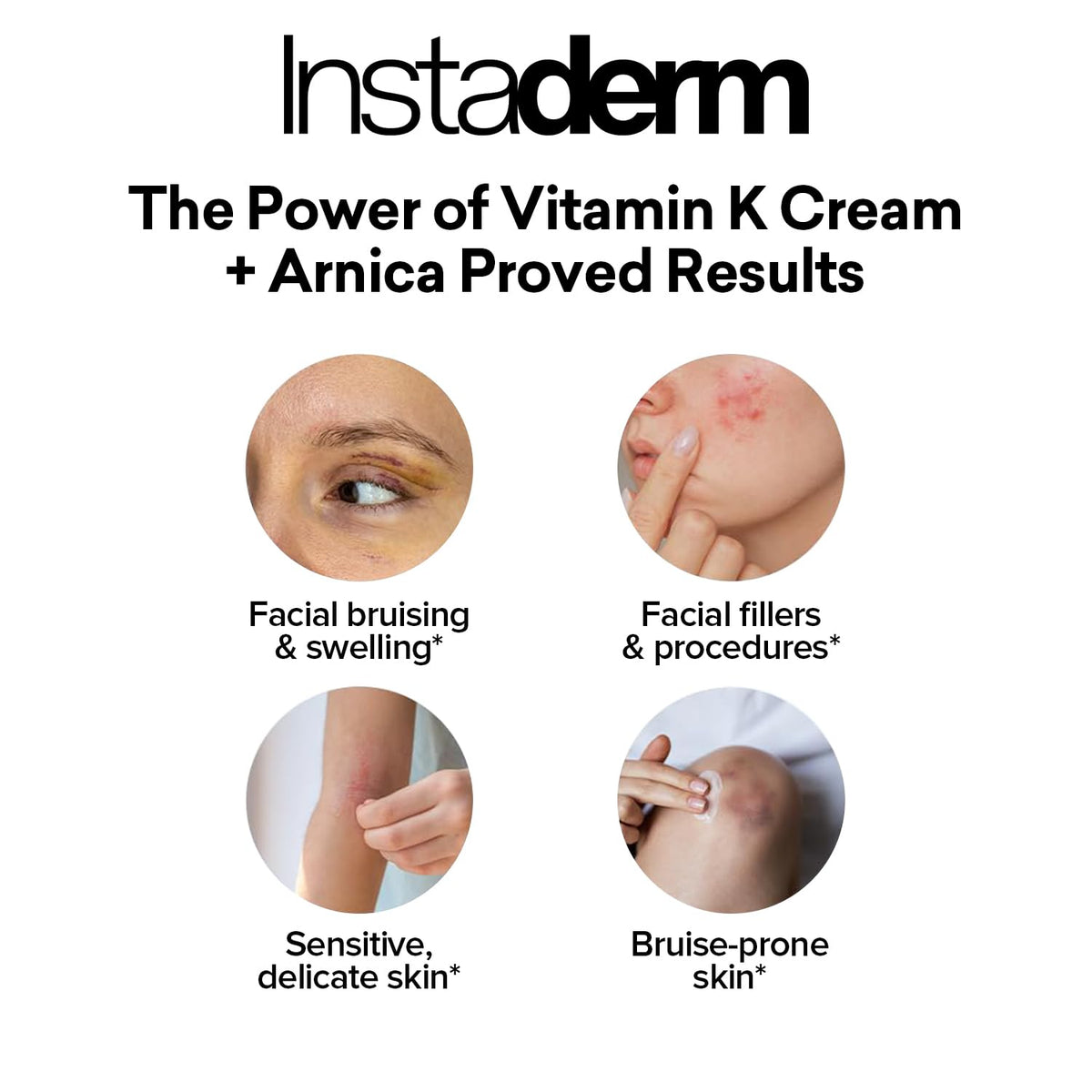 Under-eye area being treated with Instaderm cream.