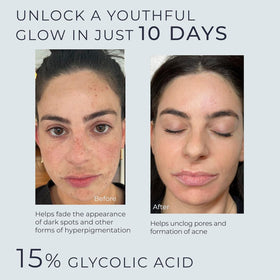 Product label close-up highlighting 15% glycolic exfoliation benefits.