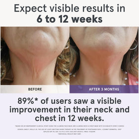 iRestore Illumina neck and chest LED mask side profile during use for comfort.