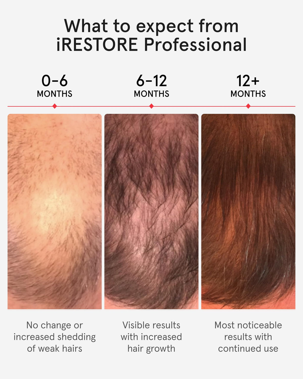 iRestore Pro crown coverage diagram emphasizes broad scalp reach.