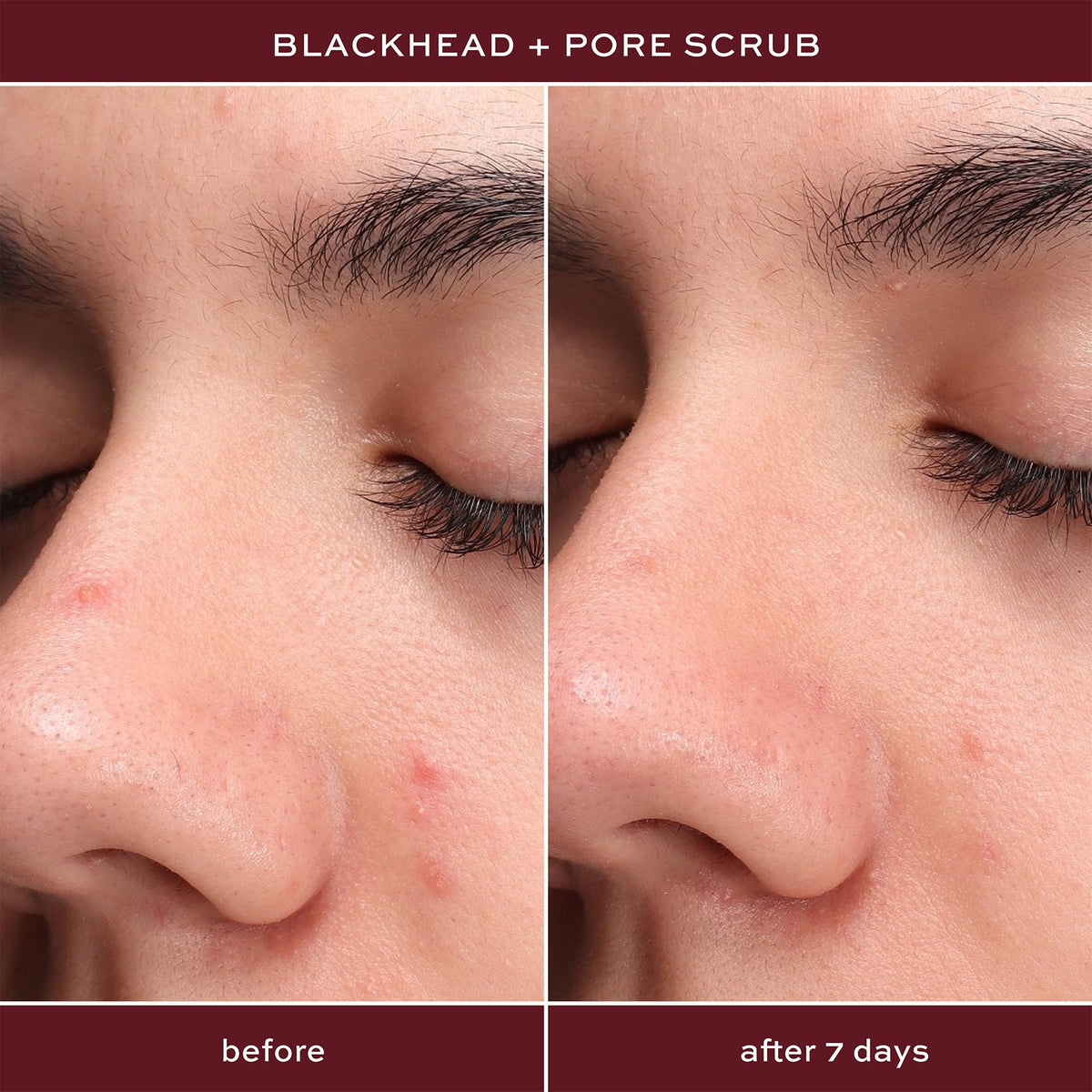 ITK skincare routine layers show step-by-step acne care.