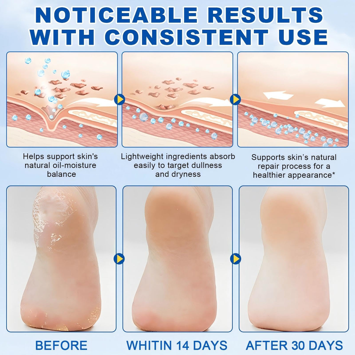 JWBVCTCR urea cream stick—skin softening after use