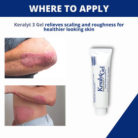 Application area on skin illustrating targeted treatment for rough patches