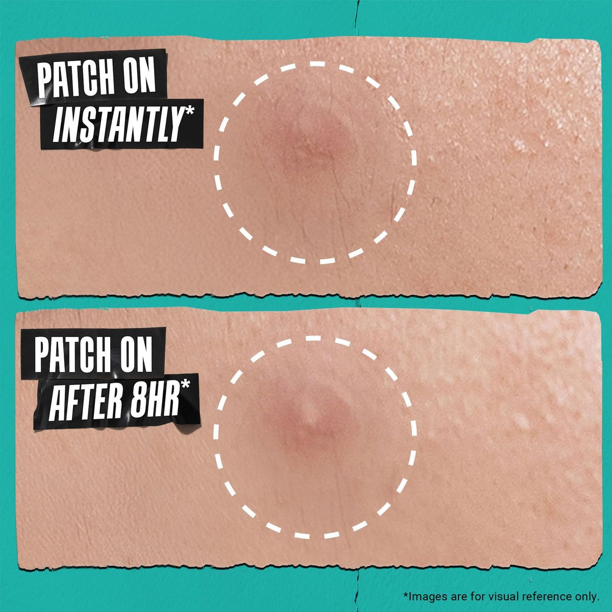 Soft, clear patch protects the blemish while you rest.