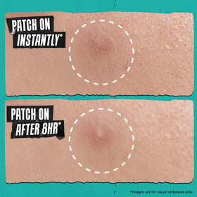 Soft, clear patch protects the blemish while you rest.