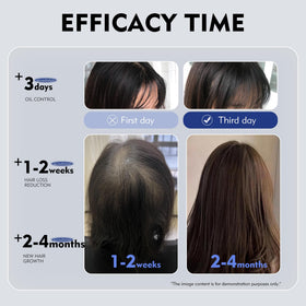 KINTOR KX-826 Pro oil-control graphic showing balanced scalp.