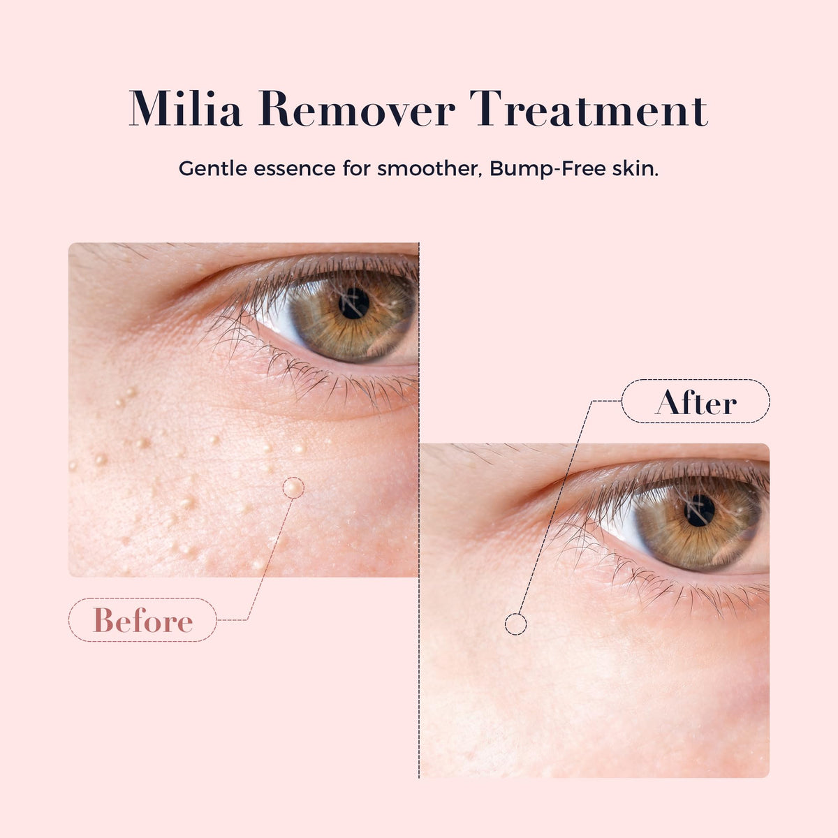Kisinly Milia Remover fluid texture close-up for quick absorption