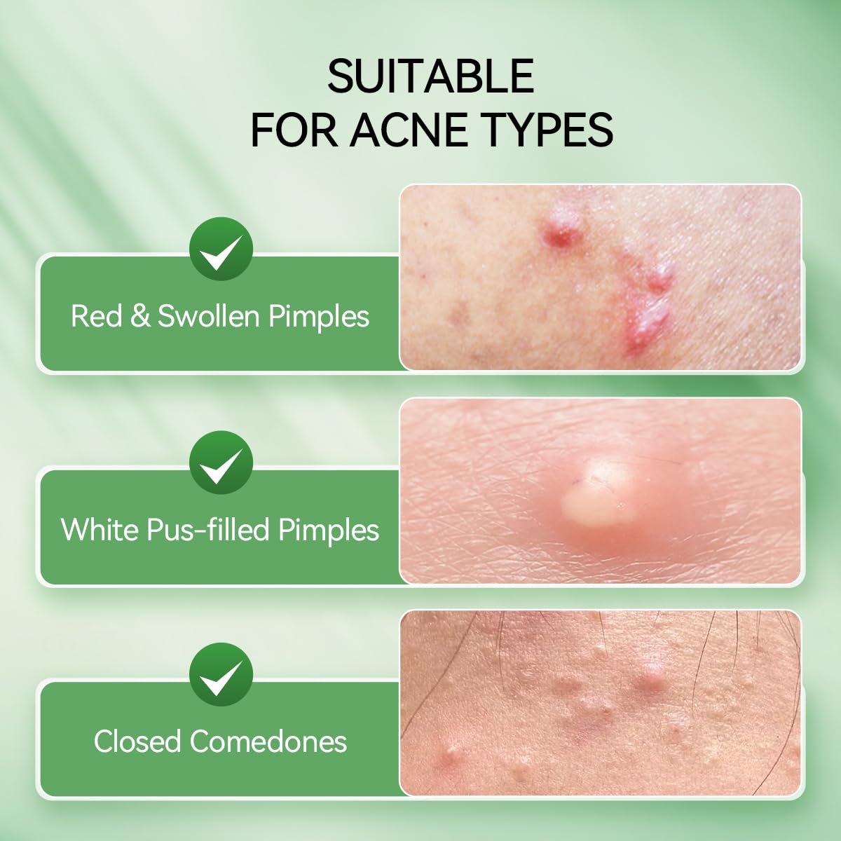 LANBENA Acne Spot Serum close-up highlights targeted treatment for pimples.