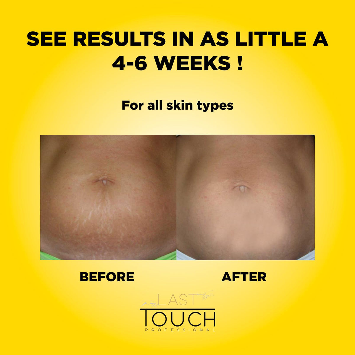 LAST TOUCH Stretch Mark Oil with shea butter and jojoba for smoother skin.