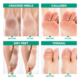 Lavinso Tea Tree Oil Foot Soak aids odor control after daily wear