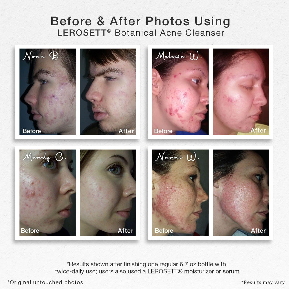 Foaming gel on hand demonstrates gentle cleansing for acne-prone skin.
