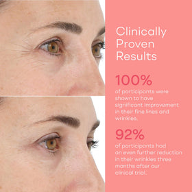 LightStim for Wrinkles crow-feet closeup shows eye-area LED therapy at work.