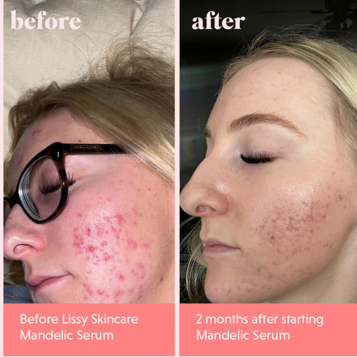 Lissy Mandelic Acid Serum Toner in bathroom setup for routine skincare