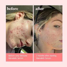 Lissy Mandelic Acid Serum Toner product shot highlights clean packaging