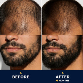 LUROUKED Minoxidil fine mist application enables precise non greasy use.