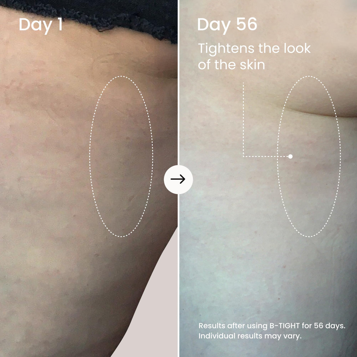 Applying MAËLYS B-TIGHT on skin for even coverage during massage.