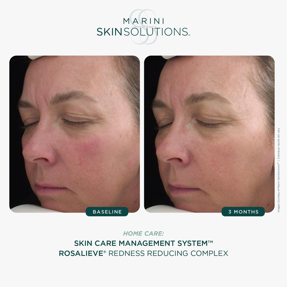 RosaLieve with azelaic acid showing calming, redness-reducing properties.