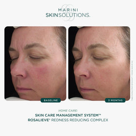 RosaLieve with azelaic acid showing calming, redness-reducing properties.
