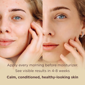 MATKAS serum being massaged into skin suggests a soothing routine.