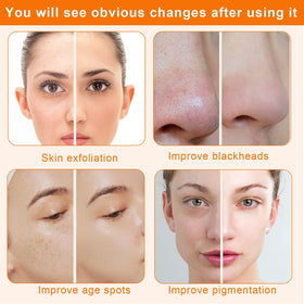 mcwdoit Diamond Microdermabrasion Machine suction detail close-up.