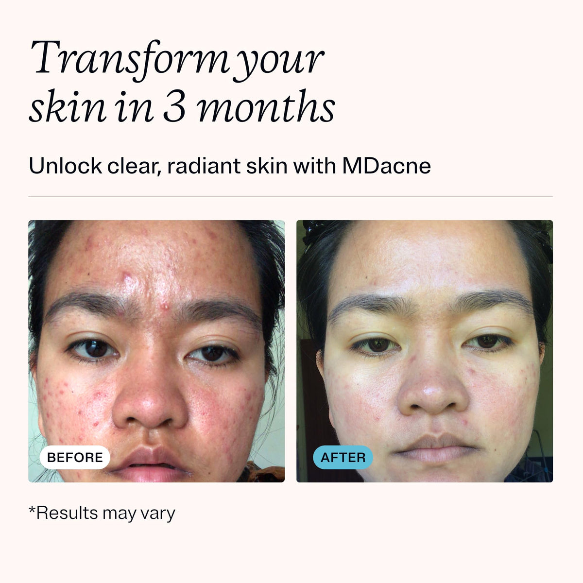 MDacne salicylic cleanser bottle helps clear pores without over-drying
