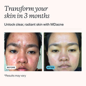 MDacne salicylic cleanser bottle helps clear pores without over-drying