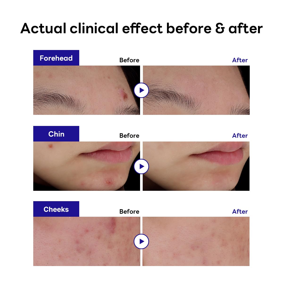Mediheal Derma Clear patch on skin shows discreet blemish coverage.