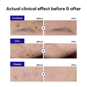 Mediheal Derma Clear Tea Tree Patch applied to a reddened blemish.