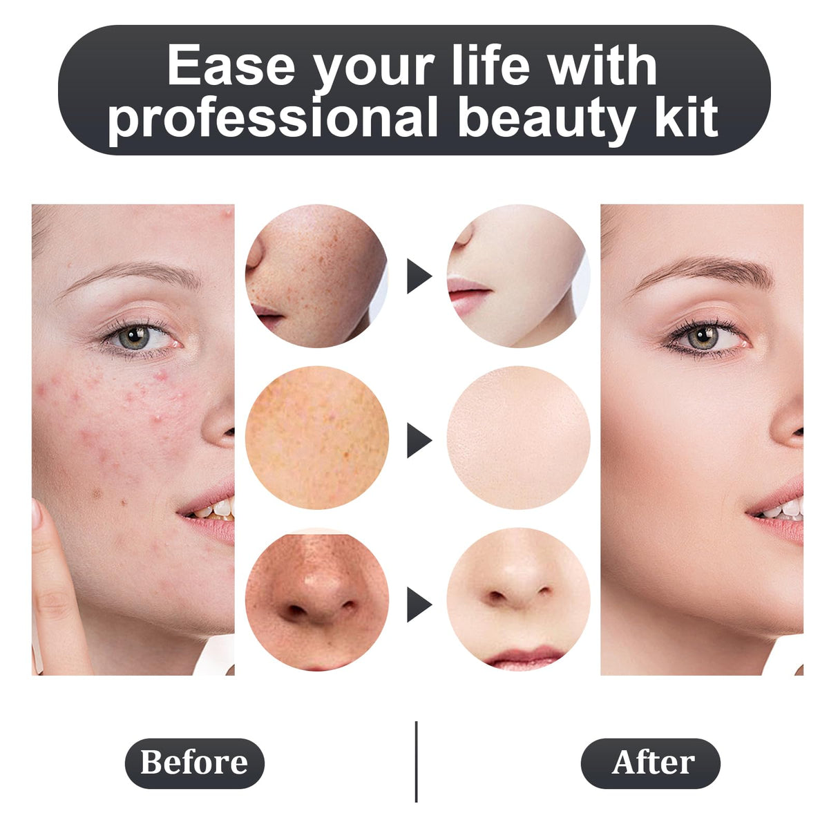 Meidaier ring tool for targeted blemish removal.