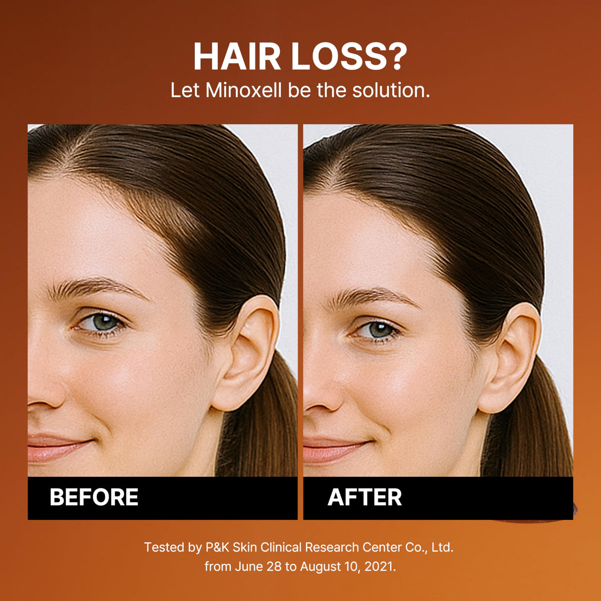 MINOXELL shampoo with salicylic acid cleanses buildup and excess oil for a refreshed scalp.