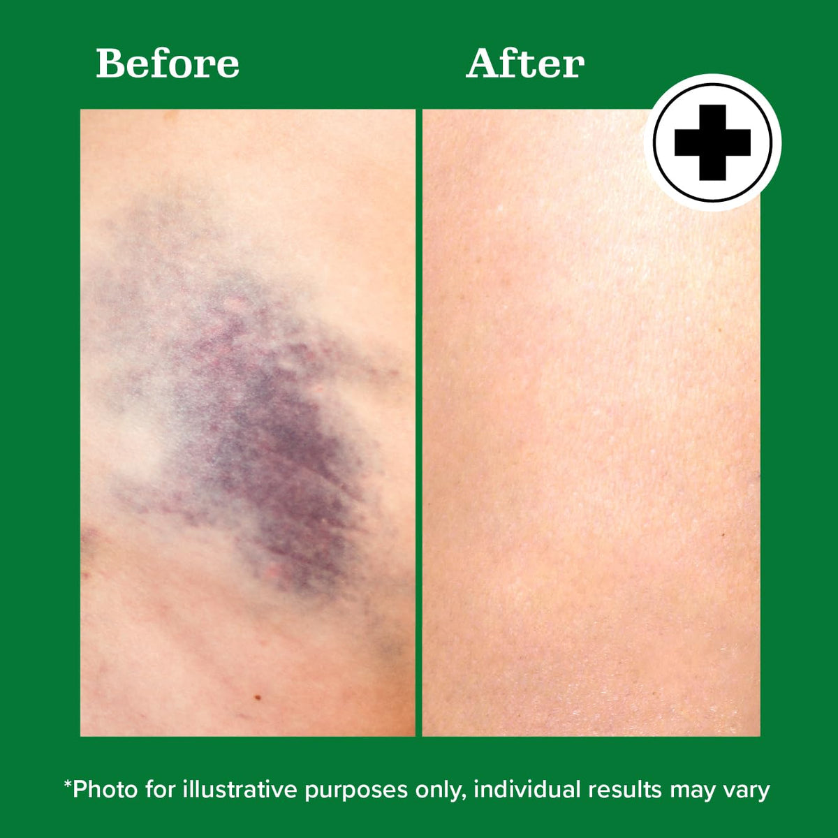 Miracle Plus Arnica Gel applied to minor bumps after workouts