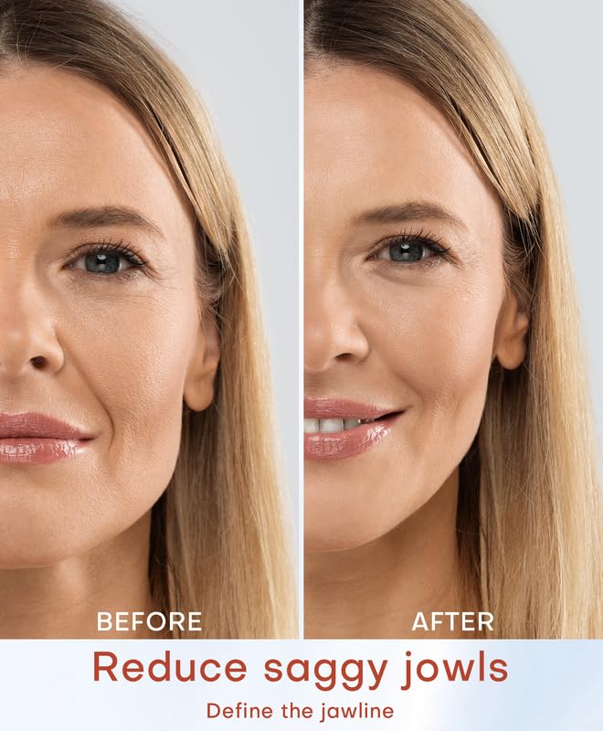MLAY large probe 50W for cheeks and jawline lifting
