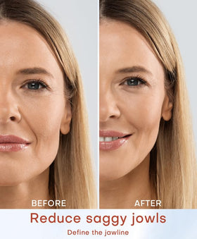 MLAY large probe 50W for cheeks and jawline lifting