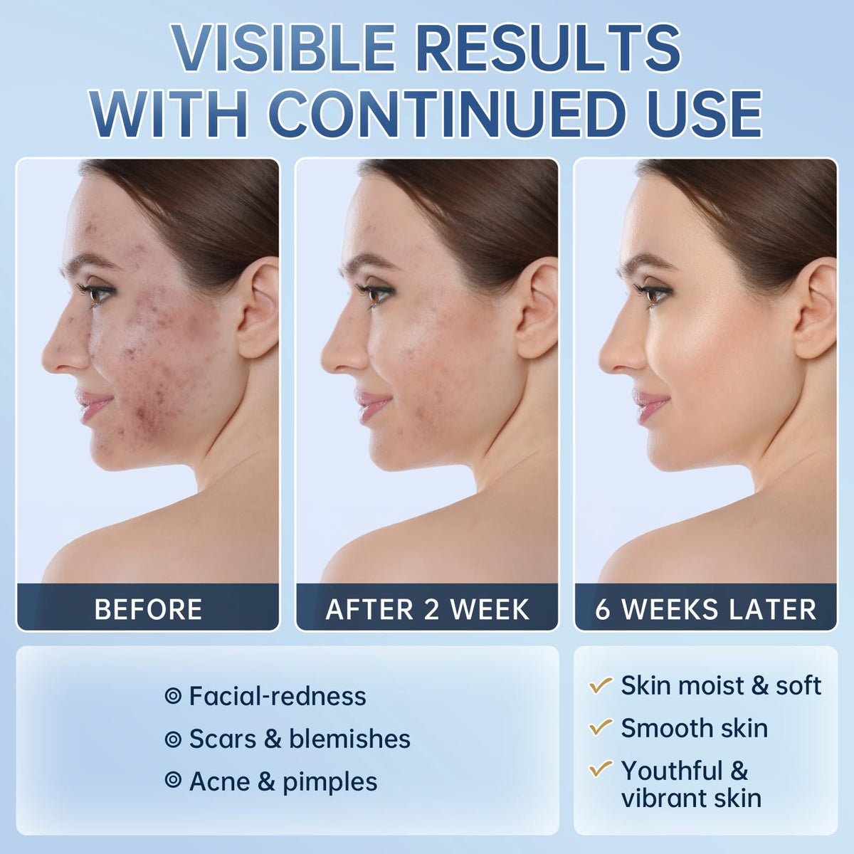 Mopayzer Azelaic Acid 14% cream redness reduction closeup under daylight