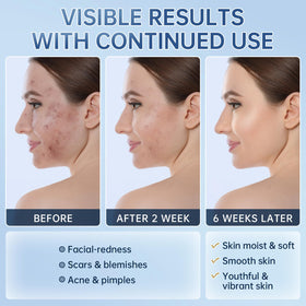 Mopayzer Azelaic Acid 14% cream redness reduction closeup under daylight