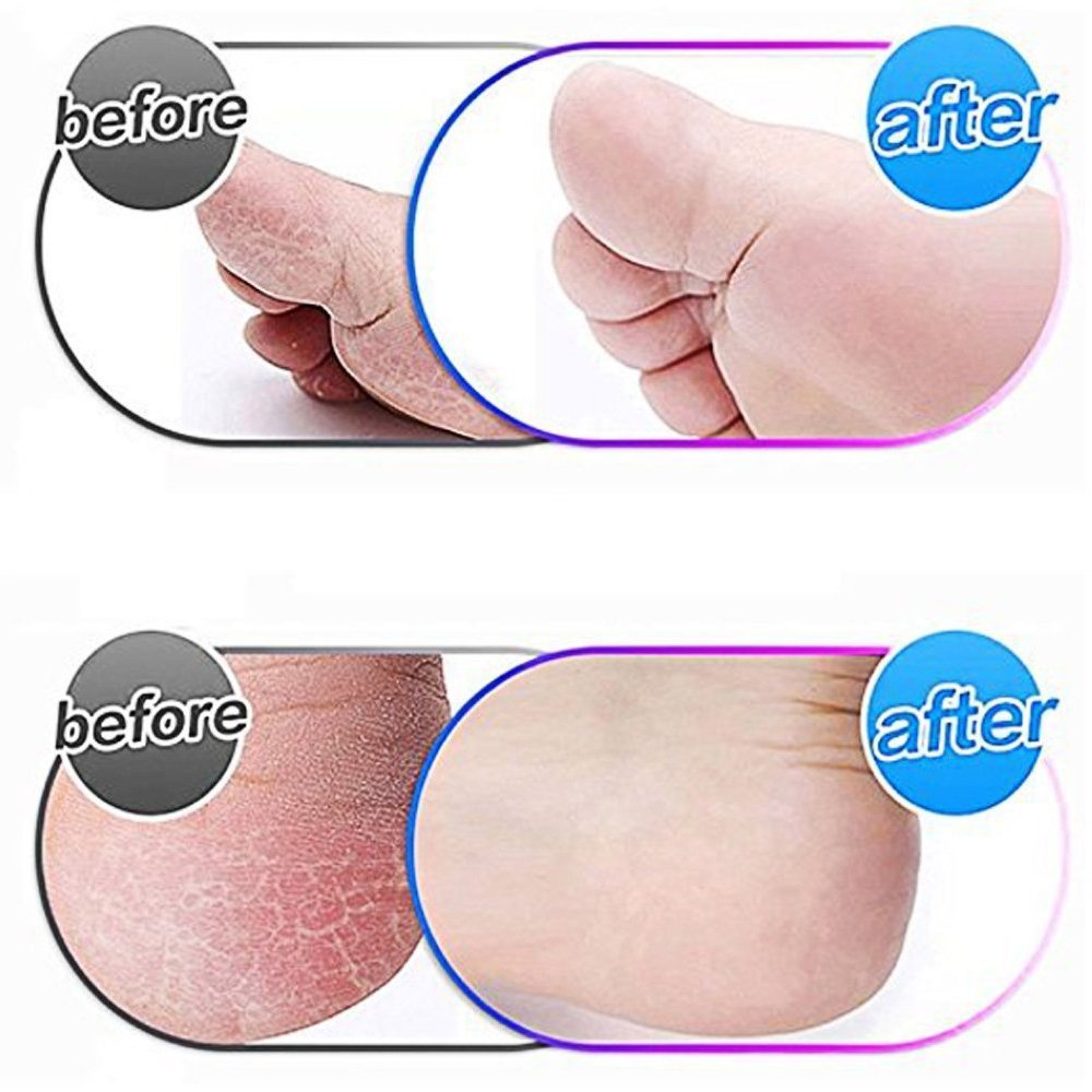 MOVELOVE blue extra coarse roller refills for effective foot care management