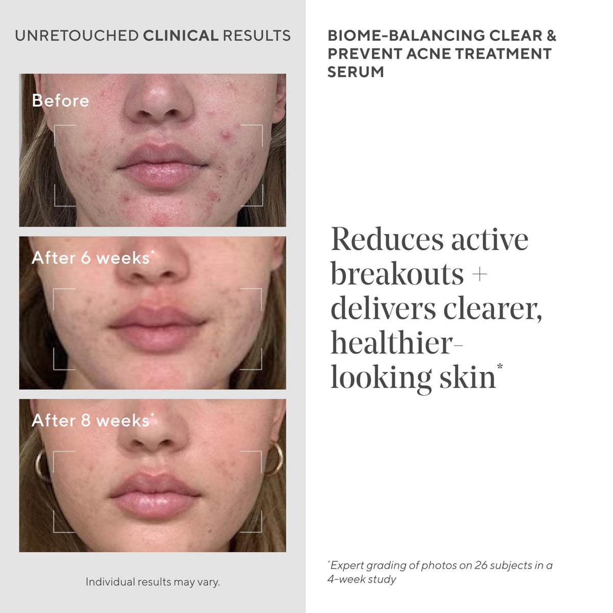 Murad Acne Trial Kit mandelic-salicylic-acid-ingredients highlight dual-action blend