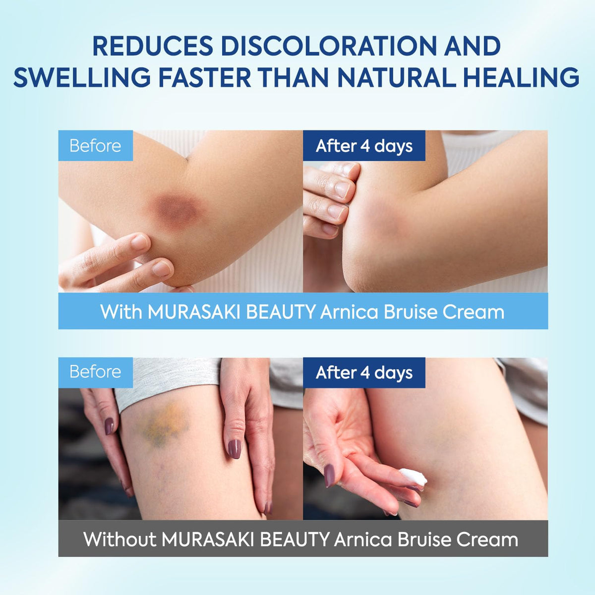 MURASAKI BEAUTY Arnica bruise cream ideal for daily use across ages.