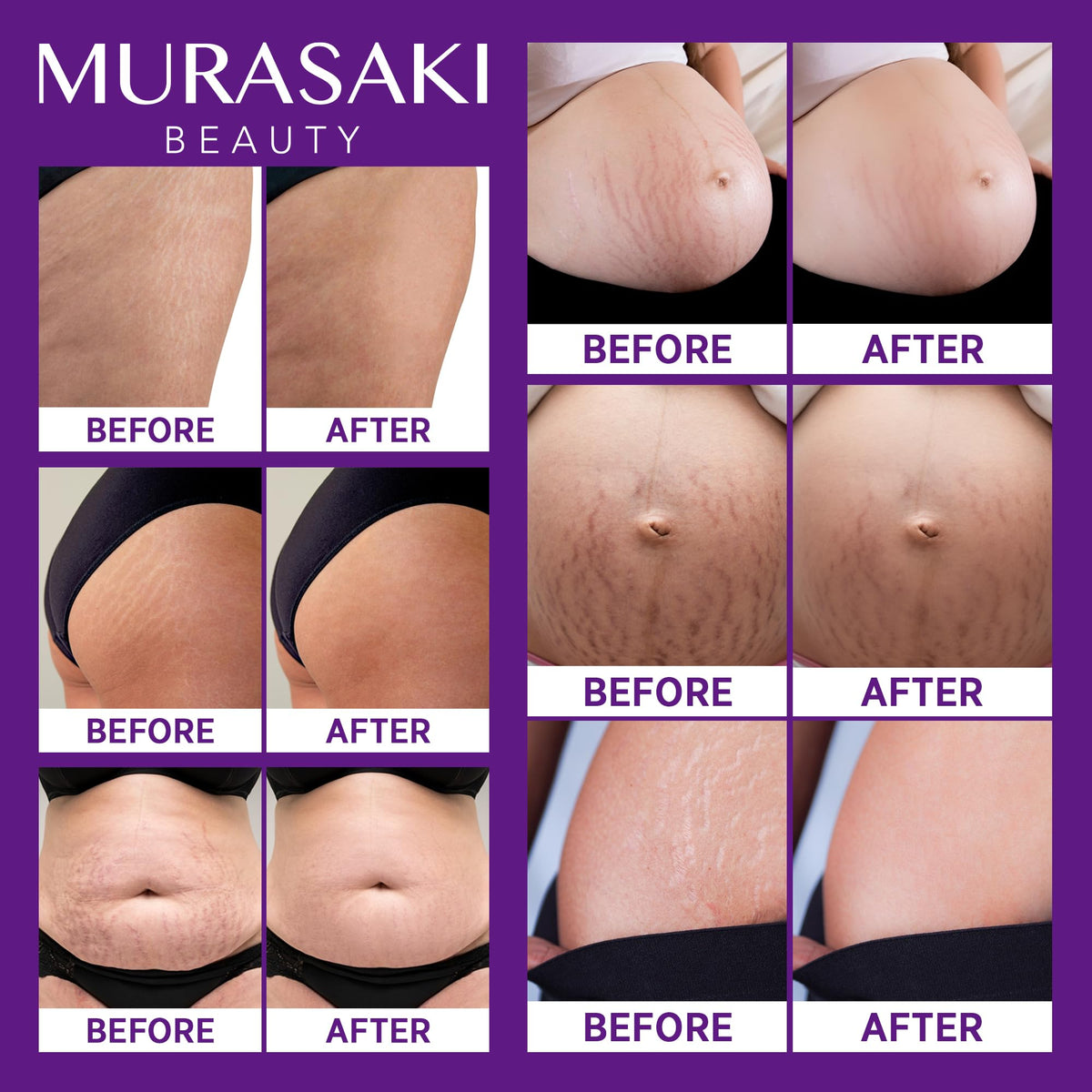 MURASAKI BEAUTY pregnancy cream applied to hips for daily care and comfort