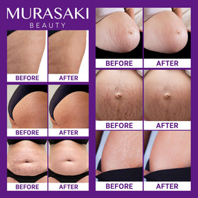 MURASAKI BEAUTY pregnancy cream applied to hips for daily care and comfort