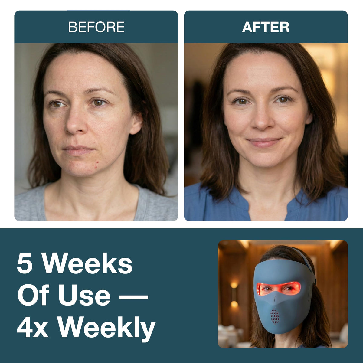 myhalos blue-light 460nm close-up emphasizes acne targeting blue light use