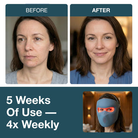 myhalos blue-light 460nm close-up emphasizes acne targeting blue light use