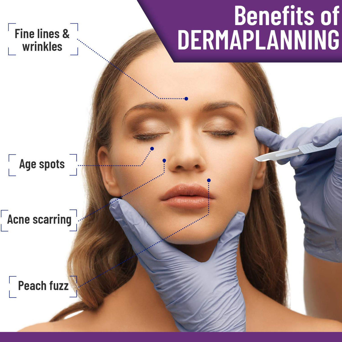 Close-up of MyMed high-carbon steel dermablade edge