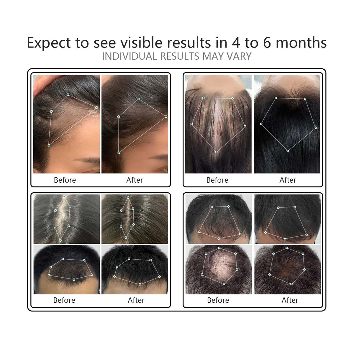 NBWTYA LaserComb teeth close-up demonstrating precise laser delivery to follicles