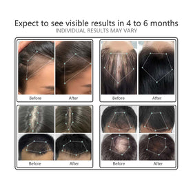 NBWTYA LaserComb teeth close-up demonstrating precise laser delivery to follicles
