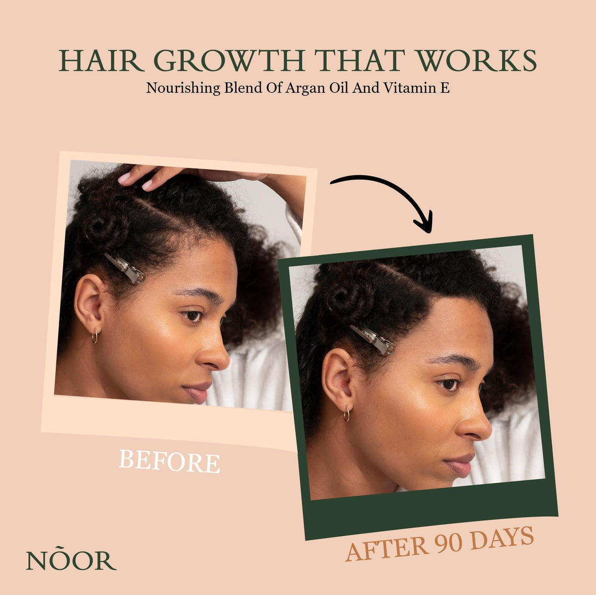 NOOR HAIR Growth Serum application to scalp supports revitalized thinning areas