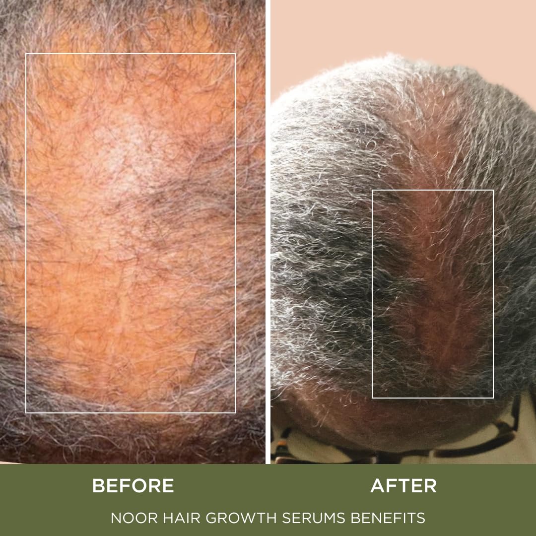 NOOR HAIR Wonder Growth Spray with green coffee bean for scalp nourishment.