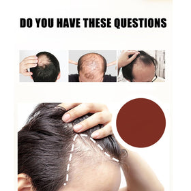 Nuaorgic hair-growth cream massaged into thinning scalp